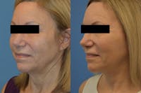 Facelift & Neck Lift Before & After Gallery - Patient 214587 - Image 1