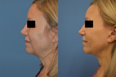 Facelift & Neck Lift Before & After Gallery - Patient 214587 - Image 2