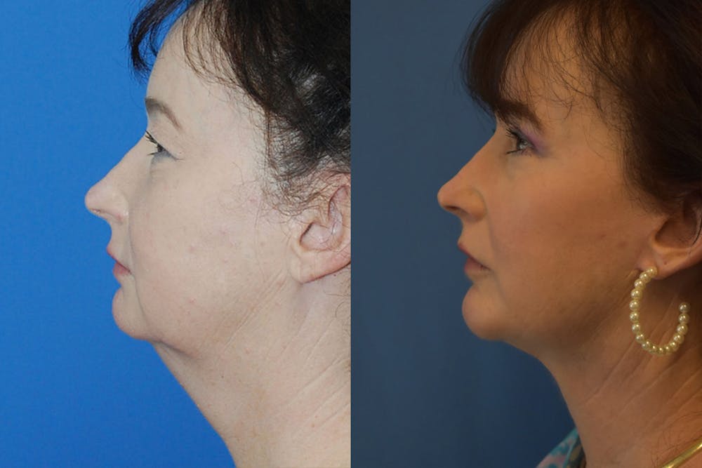 Facelift & Neck Lift Before & After Gallery - Patient 399400 - Image 1