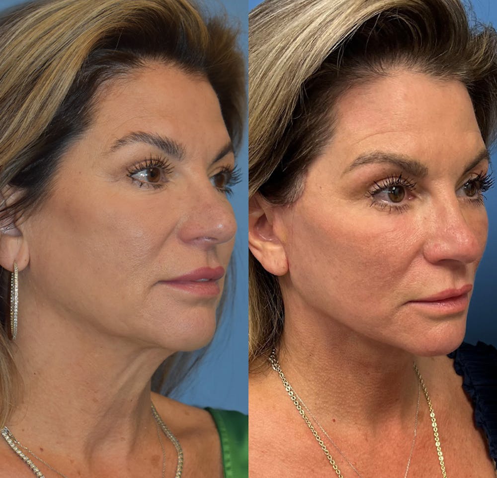 Facelift & Neck Lift Before & After Gallery - Patient 111255 - Image 2