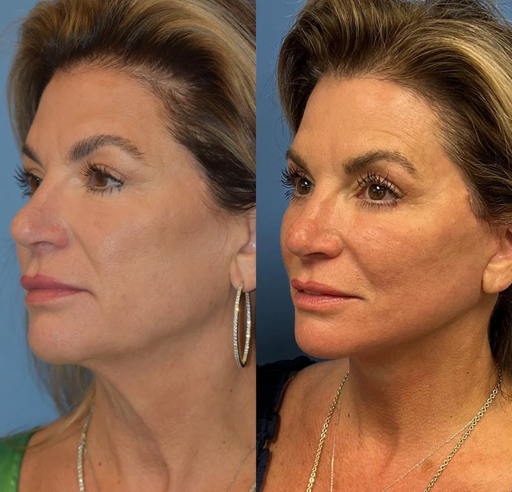Facelift & Neck Lift Before & After Gallery - Patient 111255 - Image 3