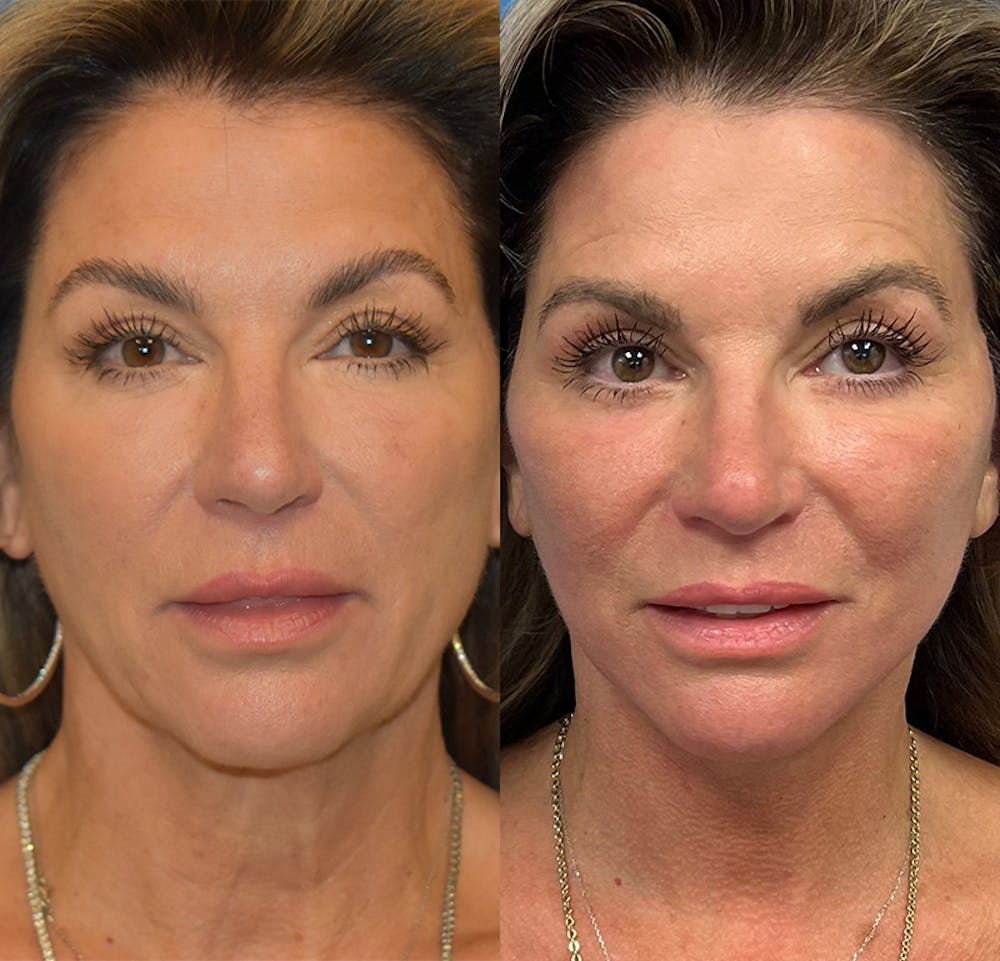Facelift & Neck Lift Before & After Gallery - Patient 111255 - Image 1