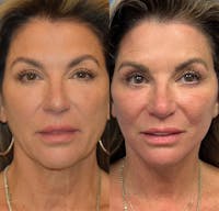 Facelift & Neck Lift Before & After Gallery - Patient 111255 - Image 1