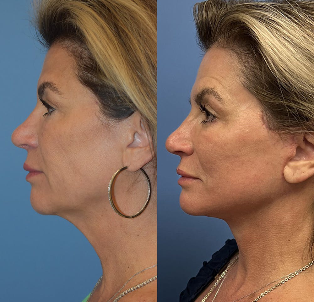 Facelift & Neck Lift Before & After Gallery - Patient 111255 - Image 4