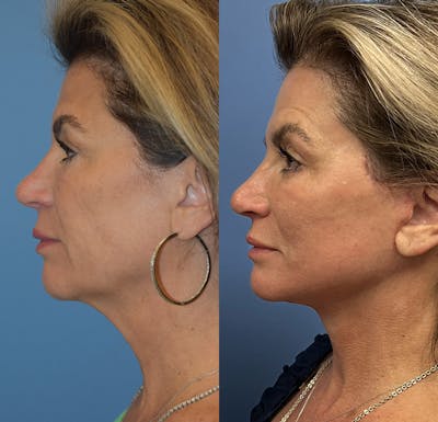 Facelift & Neck Lift Before & After Gallery - Patient 111255 - Image 4