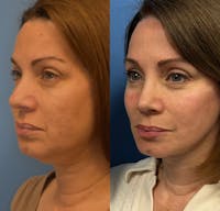 Facelift & Neck Lift Before & After Gallery - Patient 151781 - Image 1