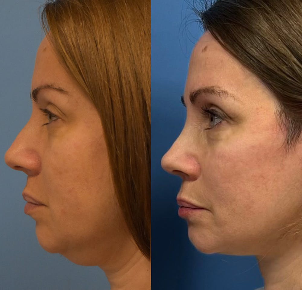 Facelift & Neck Lift Before & After Gallery - Patient 151781 - Image 2