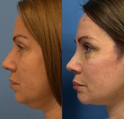 Facelift & Neck Lift Before & After Gallery - Patient 151781 - Image 2