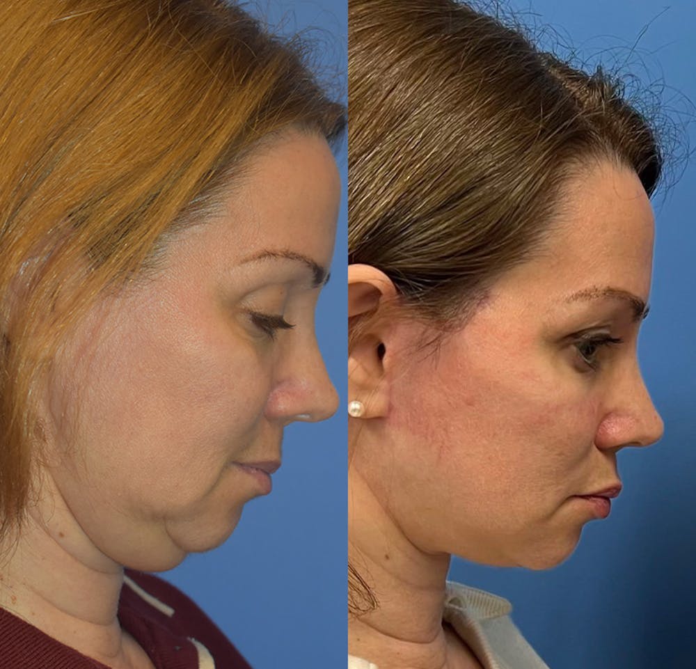 Facelift & Neck Lift Before & After Gallery - Patient 151781 - Image 3