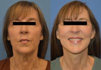Facelift & Neck Lift Before & After Gallery - Patient 665189 - Image 1