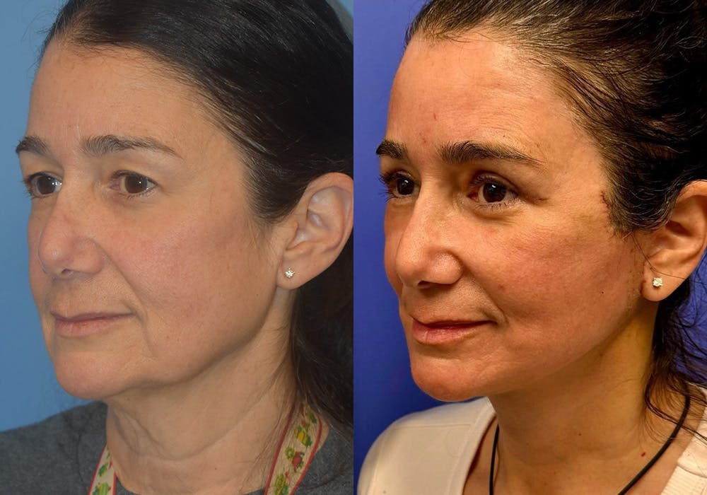 Facelift & Neck Lift Before & After Gallery - Patient 525231 - Image 1