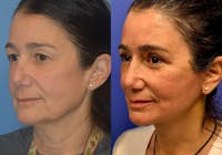 Facelift & Neck Lift Before & After Gallery - Patient 525231 - Image 1