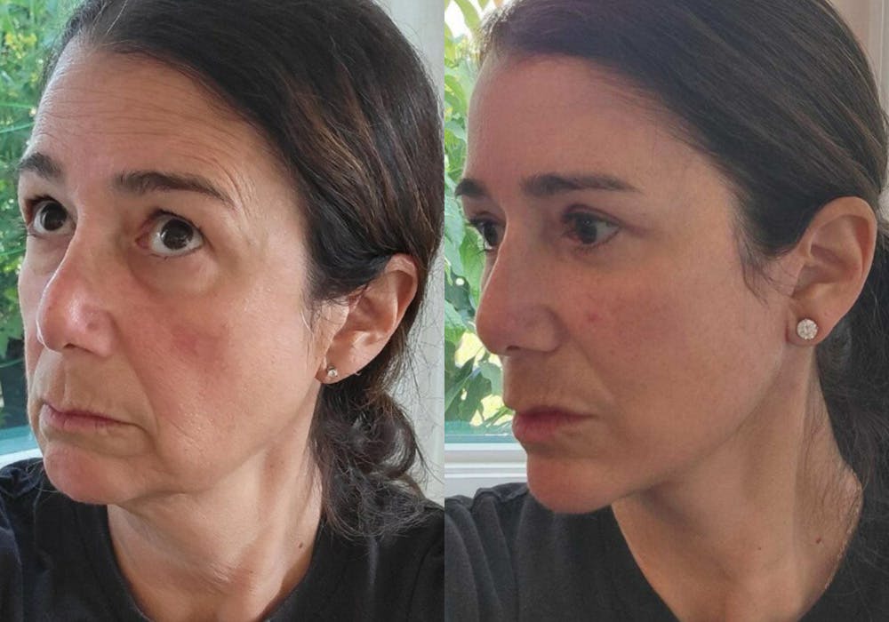 Facelift & Neck Lift Before & After Gallery - Patient 525231 - Image 2