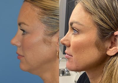 Facelift & Neck Lift Before & After Gallery - Patient 381496 - Image 4