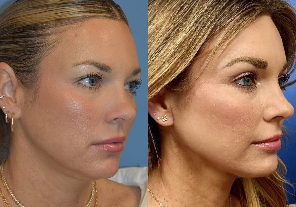 Facelift & Neck Lift Before & After Gallery - Patient 381496 - Image 2