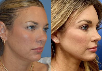 Facelift & Neck Lift Before & After Gallery - Patient 381496 - Image 2
