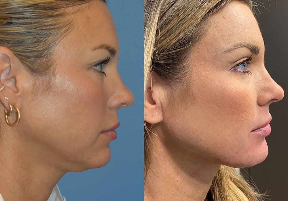 Facelift & Neck Lift Before & After Gallery - Patient 381496 - Image 1
