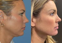 Facelift & Neck Lift Before & After Gallery - Patient 381496 - Image 1