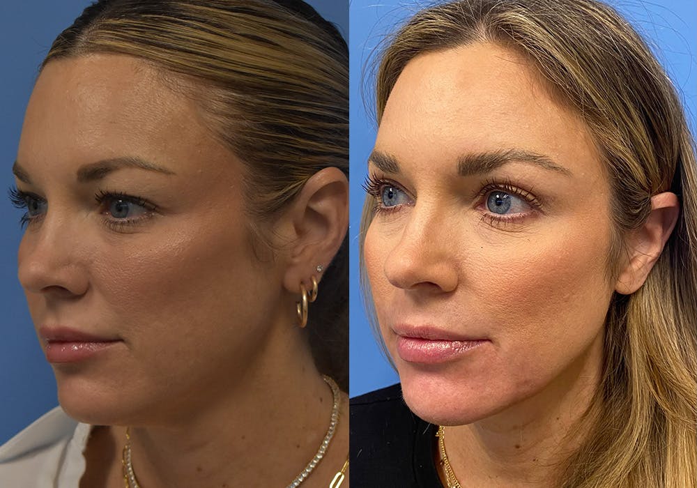 Facelift & Neck Lift Before & After Gallery - Patient 381496 - Image 3
