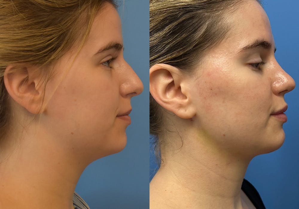 Facelift & Neck Lift Before & After Gallery - Patient 302668 - Image 1