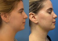 Facelift & Neck Lift Before & After Gallery - Patient 302668 - Image 1