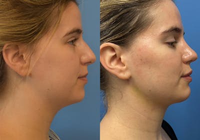Facelift & Neck Lift Before & After Gallery - Patient 302668 - Image 1
