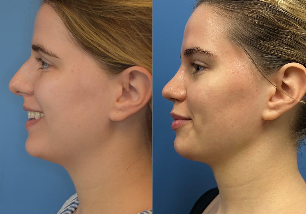 Facelift & Neck Lift Before & After Gallery - Patient 302668 - Image 2