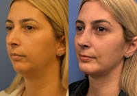 Facelift & Neck Lift Before & After Gallery - Patient 397565 - Image 1