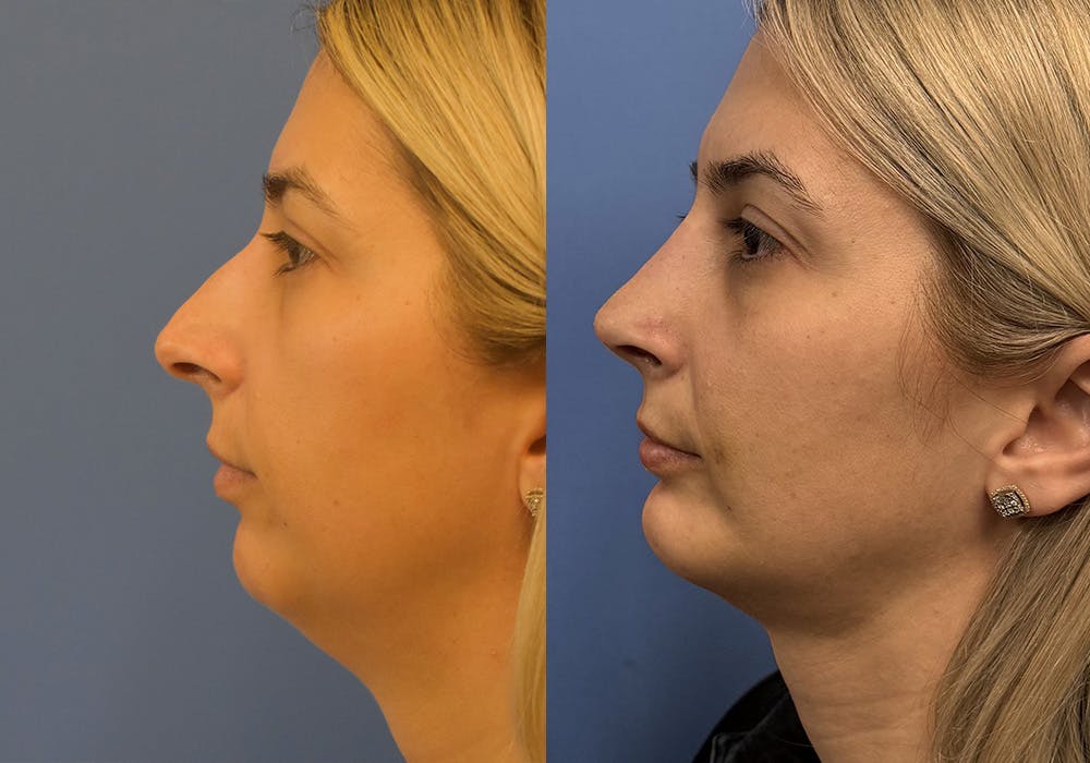 Facelift & Neck Lift Before & After Gallery - Patient 397565 - Image 2
