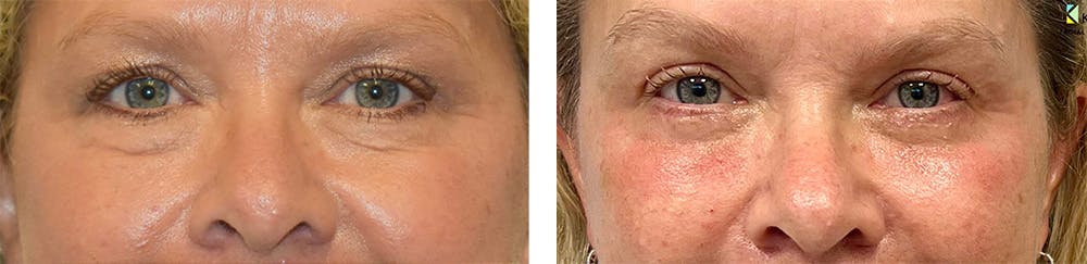 Eyelid Surgery Before & After Gallery - Patient 370664 - Image 1