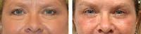 Eyelid Surgery Before & After Gallery - Patient 370664 - Image 1