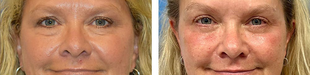 Eyelid Surgery Before & After Gallery - Patient 370664 - Image 2