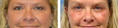Eyelid Surgery Before & After Gallery - Patient 370664 - Image 2