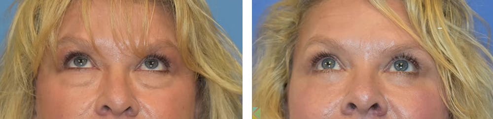 Eyelid Surgery Before & After Gallery - Patient 370664 - Image 3