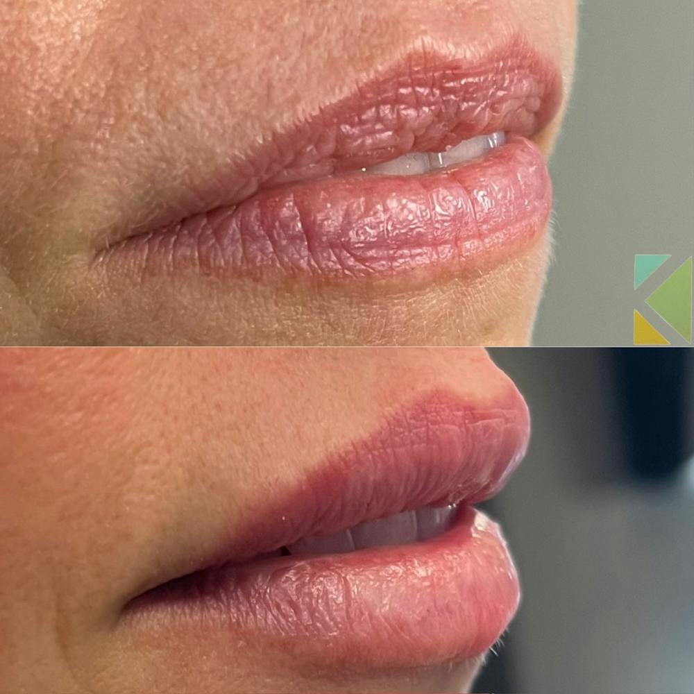 Lip Filler Before & After Gallery - Patient 260949 - Image 1