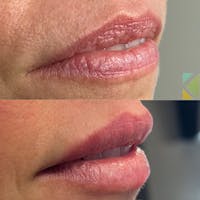 Lip Filler Before & After Gallery - Patient 260949 - Image 1