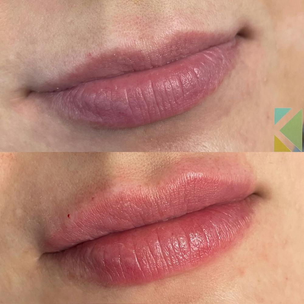 Lip Filler Before & After Gallery - Patient 165040 - Image 1