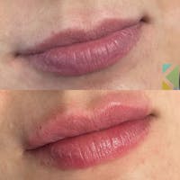 Lip Filler Before & After Gallery - Patient 165040 - Image 1