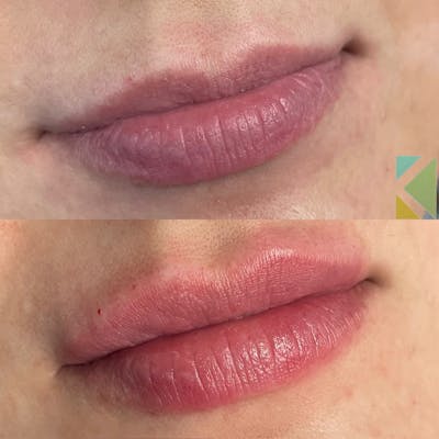 Lip Filler Before & After Gallery - Patient 165040 - Image 1