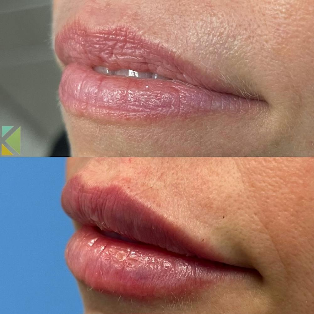 Lip Filler Before & After Gallery - Patient 381561 - Image 1