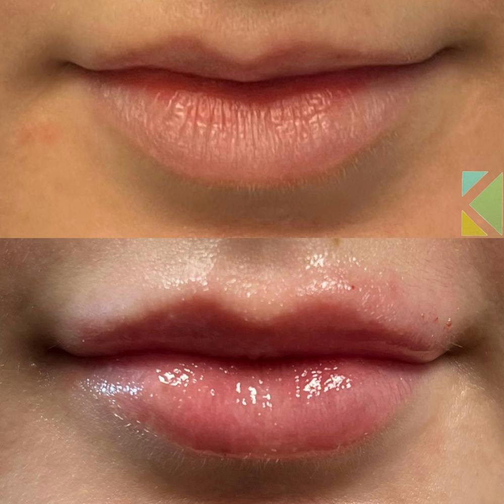 Lip Filler Before & After Gallery - Patient 184855 - Image 1