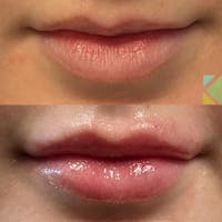 Lip Filler Before & After Gallery - Patient 184855 - Image 1