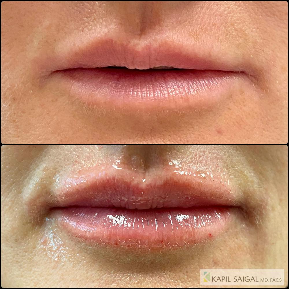Lip Filler Before & After Gallery - Patient 218892 - Image 1