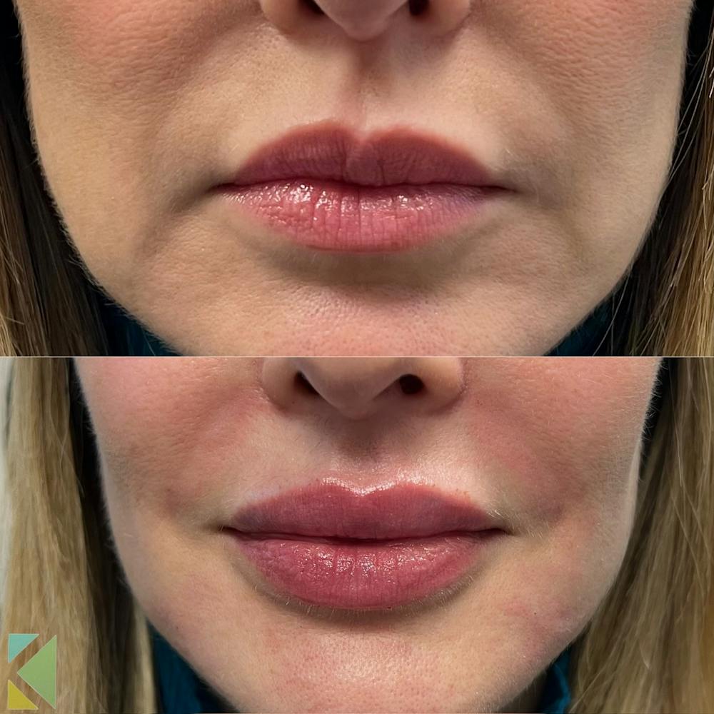 Lip Filler Before & After Gallery - Patient 151600 - Image 1