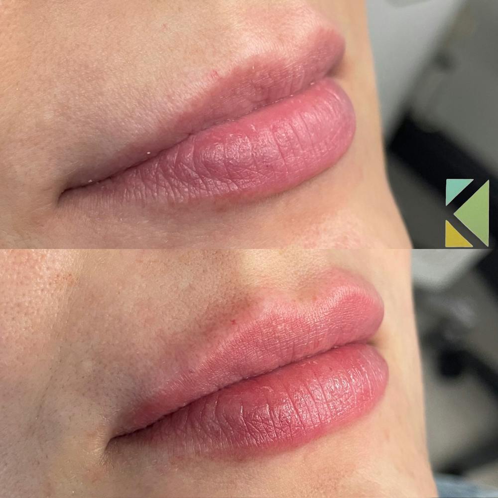 Lip Filler Before & After Gallery - Patient 186153 - Image 1
