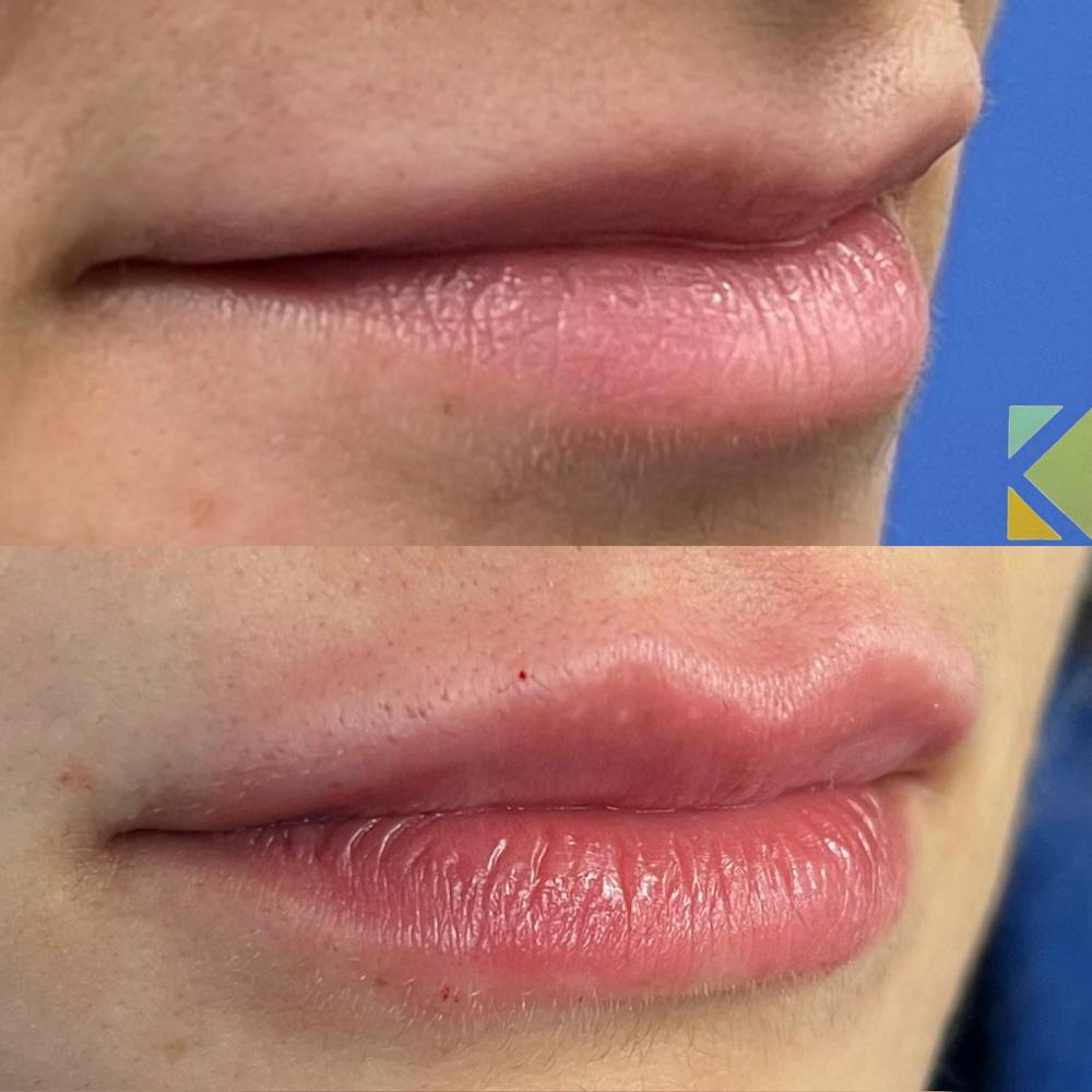 Lip Filler Before & After Gallery - Patient 222608 - Image 1