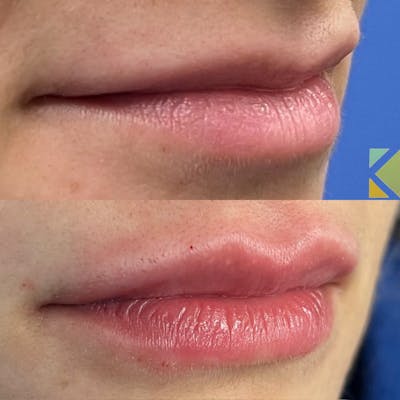 Lip Filler Before & After Gallery - Patient 222608 - Image 1