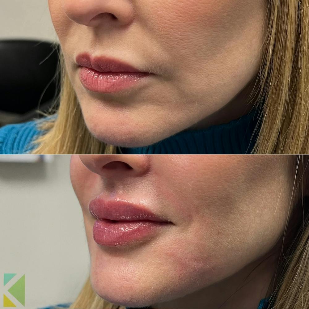 Lip Filler Before & After Gallery - Patient 997714 - Image 1