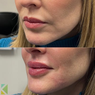 Lip Filler Before & After Gallery - Patient 997714 - Image 1