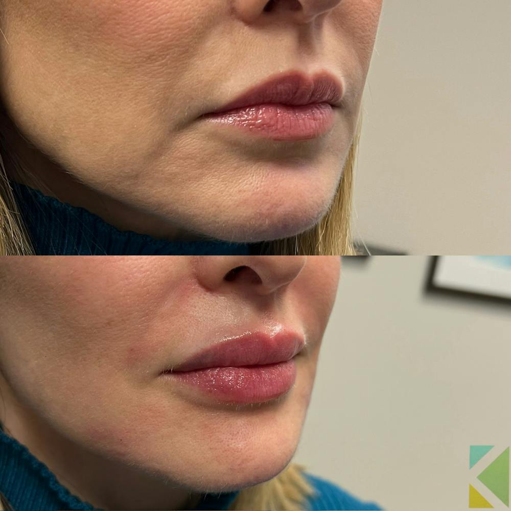 Lip Filler Before & After Gallery - Patient 226548 - Image 1
